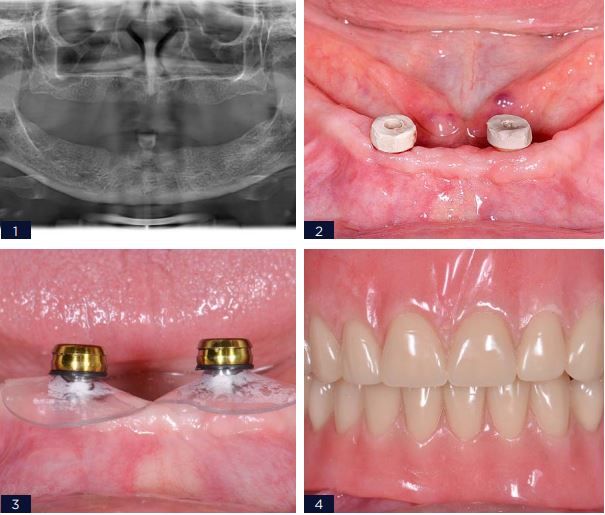 PROTESE OVERDENTURE SOBRE COMPONENTES CUSTOMIZADOS - Arcsys pelo mundo