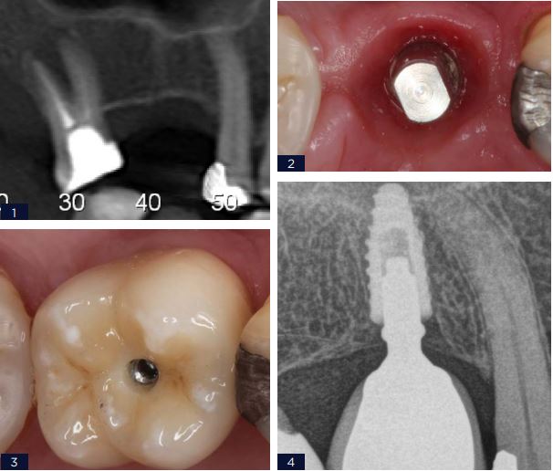 PROTESE UNITARIA COPING FRICCIONAL - Arcsys pelo mundo