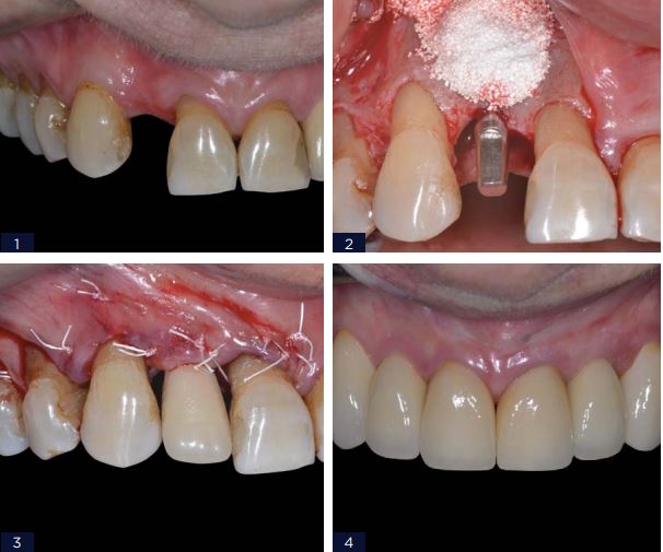 REABILITACAO DENTO ALVEOLAR COM IMPLANTE ARCSYS ENXERTO CONJUNTIVO E SUBSTITUTO OSSEO - Arcsys pelo mundo