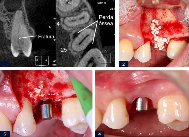 RECONSTRUCAO ALVEOLAR APOS - Arcsys pelo mundo