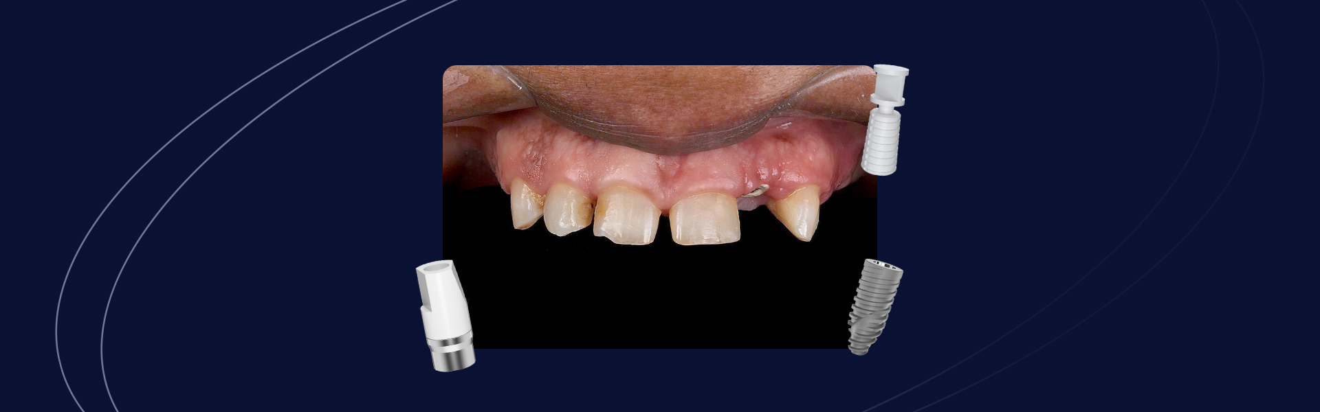 Reabilitacao ceramica sobre dentes e implantes o uso do fluxo digital em sua totalidade - Reabilitação cerâmica sobre dentes e implantes: o uso do fluxo digital em sua totalidade