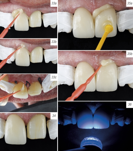 Site 33a b c 34 35a b 36 - Harmonizando sorrisos por meio de laminados cerâmicos: passo a passo de um protocolo previsível