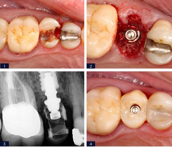 USO DE IMPLANTE FRICCIONAL EM CARGA IMEADIATA POS FRATURA DENTARIA - Arcsys pelo mundo