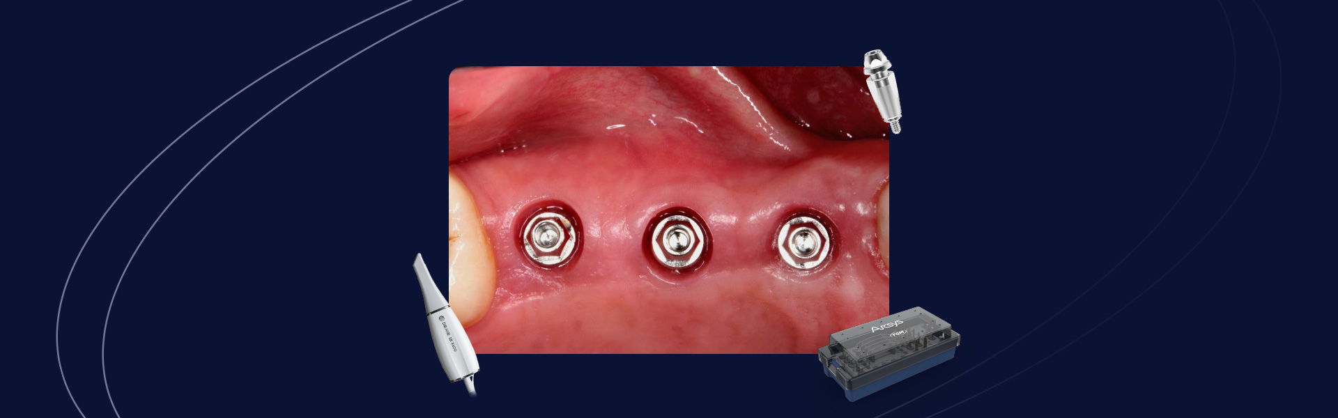 Fluxo digital na implantodontia da cirurgia a protese - Fluxo digital na implantodontia: da cirurgia à prótese