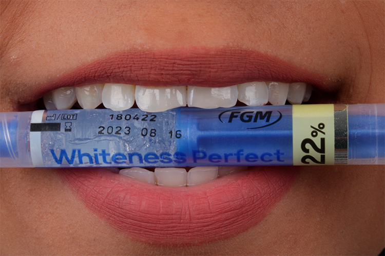 8 | Whiteness Perfect 22% was chosen for take-home using technique for 15 days (every 7 days we carry out a control consultation) whitening