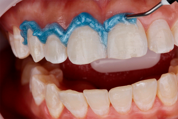 4 | Protection with Top Dam gingival barrier.