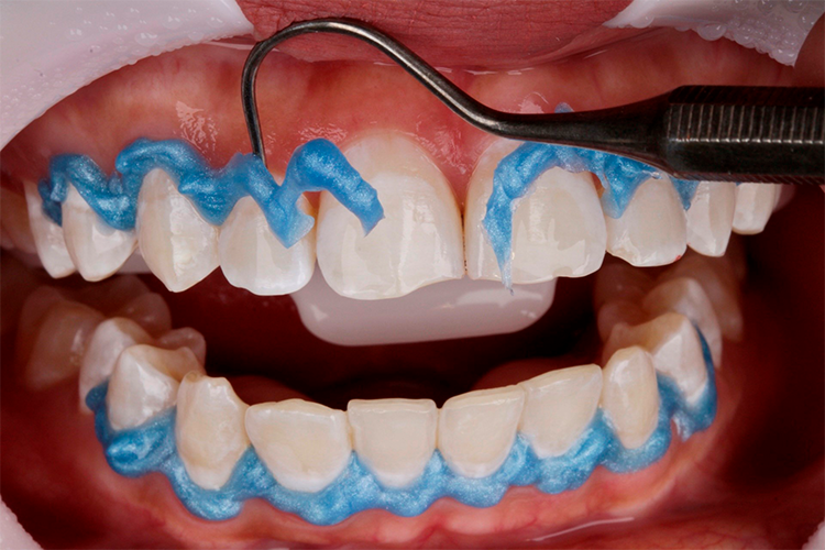 7 | We remove the Top Dam gingival barrier