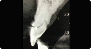 1 Tomografia inicial - Sistema de Implantes Arcsys