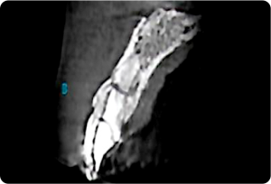 1 Tomografia inicial do elemento fraturado - Sistema de Implantes Arcsys