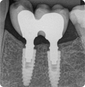 2 Manutencao ossea sobre a plataforma do componente - Sistema de Implantes Arcsys