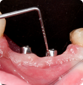 3 Acompanhamento clinico de 6 anos - Sistema de Implantes Arcsys