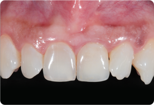 3 Acompanhamento clinico evidenciando a estabilidade peri implantar da conexao friccional - Sistema de Implantes Arcsys