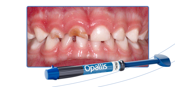 05_Capa-Reabilitação-estética-com-coroa-de-acetato-e-resina-unicromática-em-odontopediatria