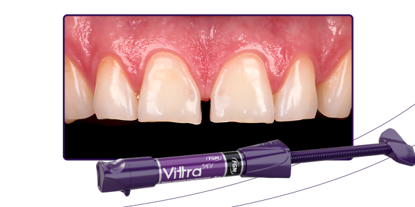 06_Capa-Restauração-estética-e-funcional-com-facetas-em-resina-composta-transformando-o-sorriso-do-paciente