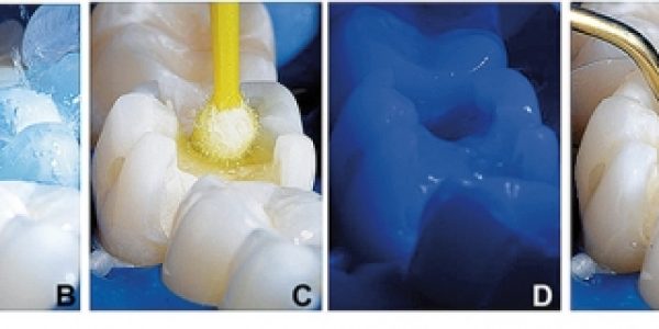 Sequência clínica do condicionamento ácido, aplicação do adesivo e incrementos de resina iniciais em outra vista