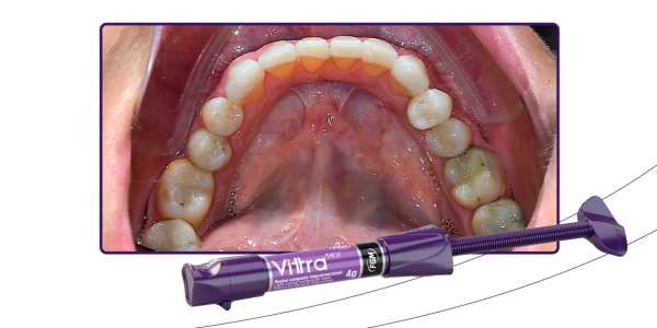 15_Capa-Reabilitação-indireta-com-resina-pela-técnica-da-matriz-de-silicone-transparente