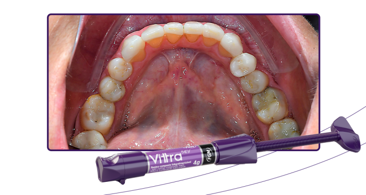 15_Capa-Reabilitação-indireta-com-resina-pela-técnica-da-matriz-de-silicone-transparente