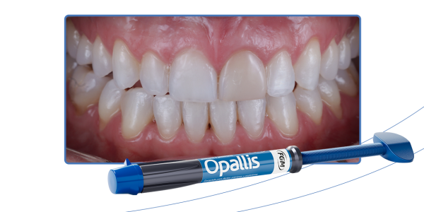 19_Capa-Restauração-estética-em-resina-composta-sobre-dente-escurecido