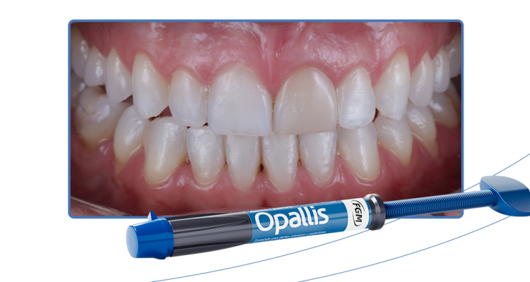 19_Capa-Restauração-estética-em-resina-composta-sobre-dente-escurecido