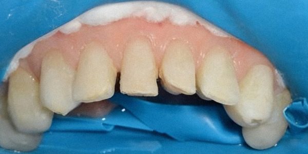 Fechamento de diastema e correção de forma e volume dos dentes com resina composta Vittra APS