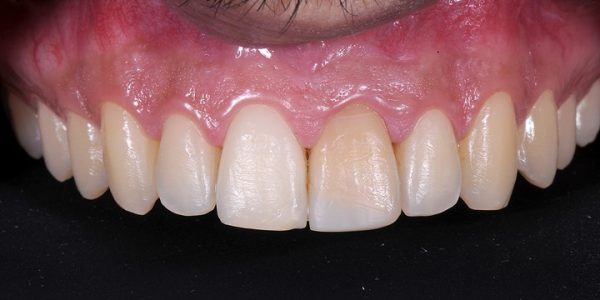 5 - Vista aproximada dos dentes superiores, onde observamos que o dente 11 apresenta cor mais clara com grande discrepância quando comparado aos dentes posteriores e ao dente 21. A estratégia de