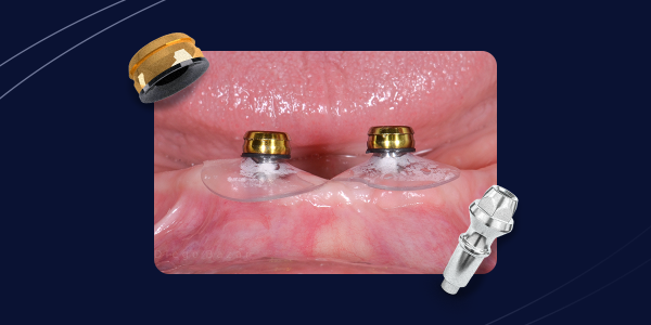 Capa-Overdenture-Caso