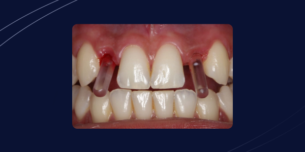 Cirurgia guiada em agenesia dentária