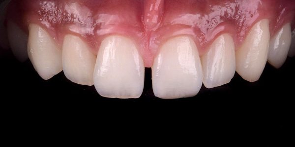 Fig 2 Aspecto inicial intra-oral com contraste