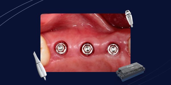 Fluxo-digital-na-implantodontia-da-cirurgia-à-prótese