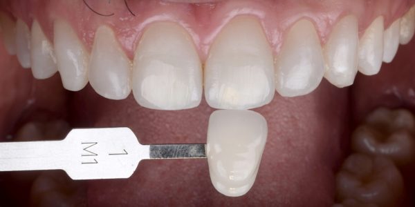 Intrabucal frontal comparando com a escala de cores VITA Clássica compatível com a cor final obtida após o clareamento.