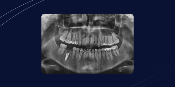 Implante Friccional em Região Posterior