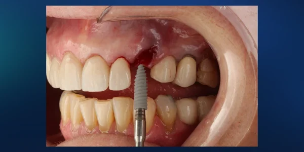 Implantes dentários – guia definitivo para transformar seu sorriso