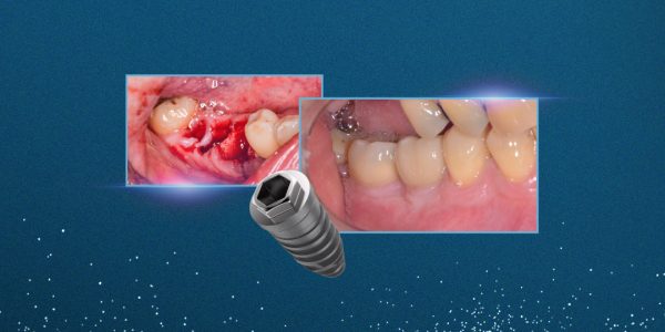 Manutenção óssea Alveolar Com Nanosynt E Implantes Dentários Hexágono Externo Vezza