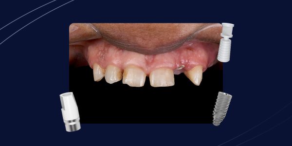 Reabilitação-cerâmica-sobre-dentes-e-implantes-o-uso-do-fluxo-digital-em-sua-totalidade