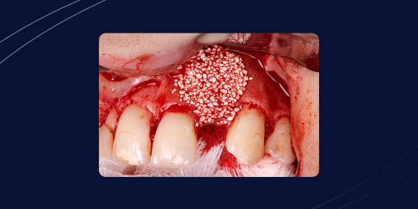 Regeneração óssea guiada em área estética