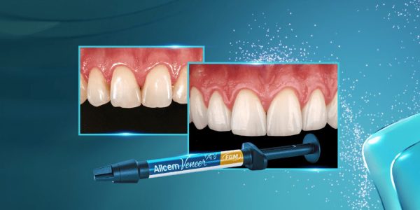 Restabelecimento do corredor bucal e do sorriso com cirurgia plástica periodontal e laminados cerâm