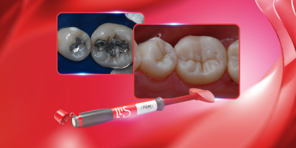 Substituição de restaurações de amálgama por resina composta