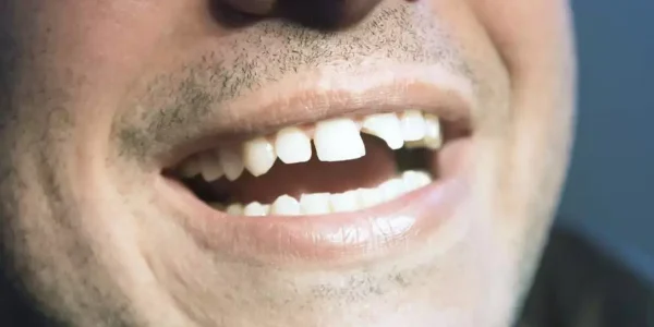 dente-quebrou-o-que-fazer