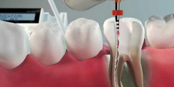 A anatomia surpreendente dos dentes: descubra como até quatro canais podem afetar sua saúde bucal